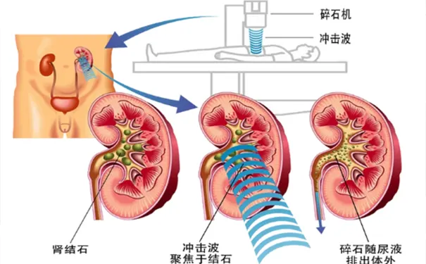 杭州体外碎石费用