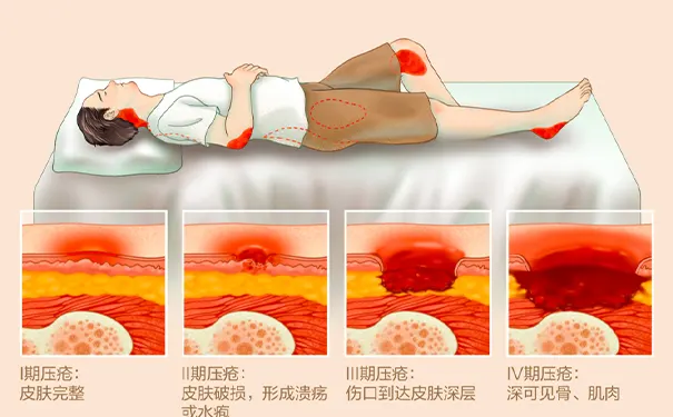 预防褥疮 预防褥疮